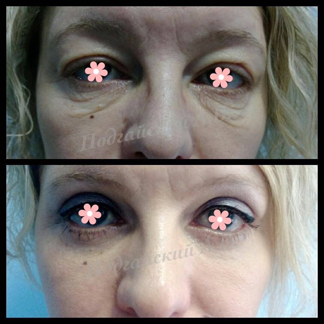 Блефаропластика верхних век