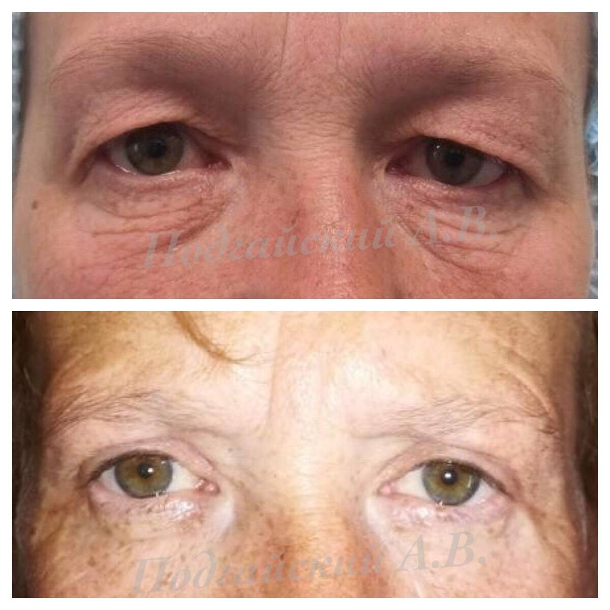 Блефаропластика верхних век, пациентке 1958 г.р.