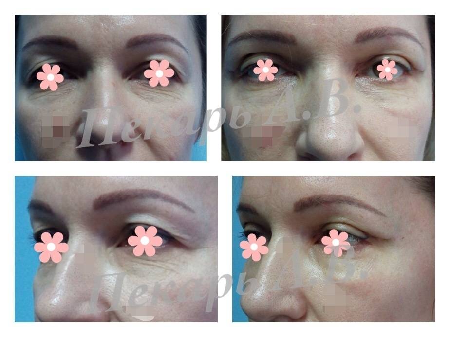 Блефаропластика верхних век